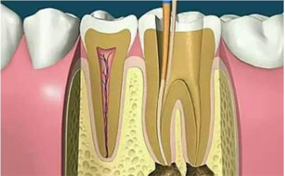 尋找根管口的八種方法 尋找根管口的八種方法