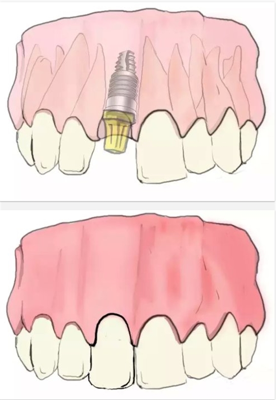 種植【最全的種植牙介紹】 種植【最全的種植牙介紹】
