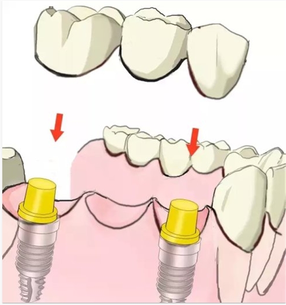 種植【最全的種植牙介紹】 種植【最全的種植牙介紹】