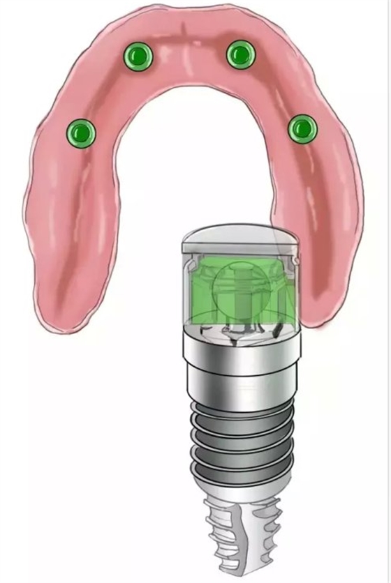 種植【最全的種植牙介紹】 種植【最全的種植牙介紹】