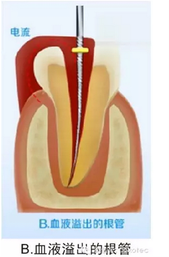 讓你知道根管測量受影響的原因 讓你知道根管測量受影響的原因