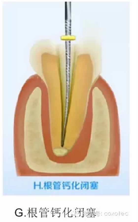 讓你知道根管測量受影響的原因 讓你知道根管測量受影響的原因