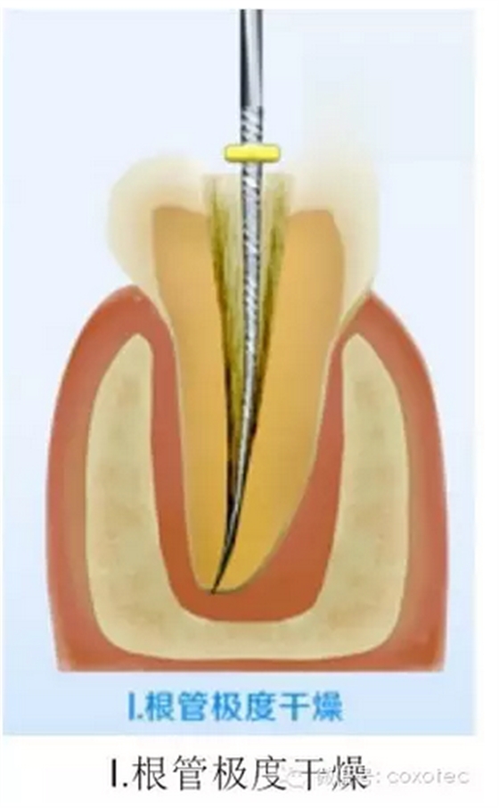 讓你知道根管測量受影響的原因 讓你知道根管測量受影響的原因