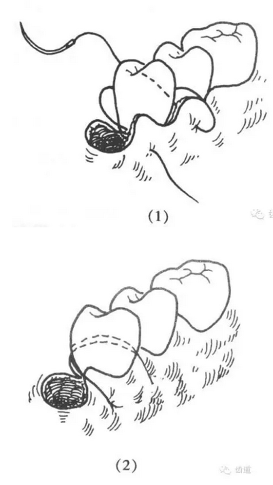 牙醫(yī)基本技能：口內(nèi)縫合術(shù)（文字、示意圖及視頻）
