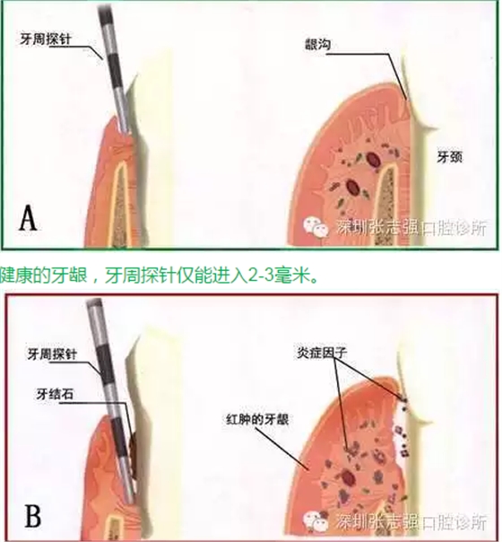 刷牙出血，牙齦紅腫，并非缺乏維生素