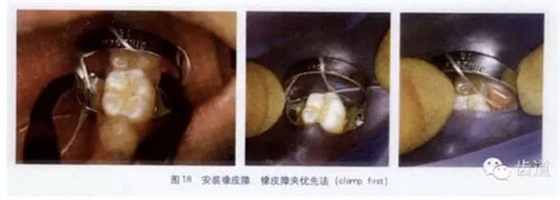 橡皮障的臨床運(yùn)用大全 橡皮障的臨床運(yùn)用大全