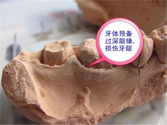 備牙應(yīng)注意的事項(xiàng)+備牙取摸損傷牙齦問題