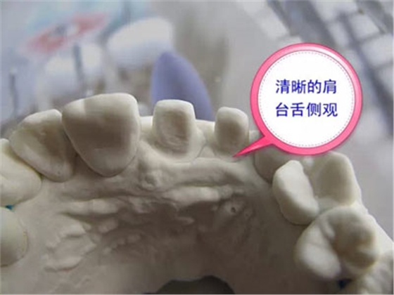 備牙應(yīng)注意的事項(xiàng)+備牙取摸損傷牙齦問題