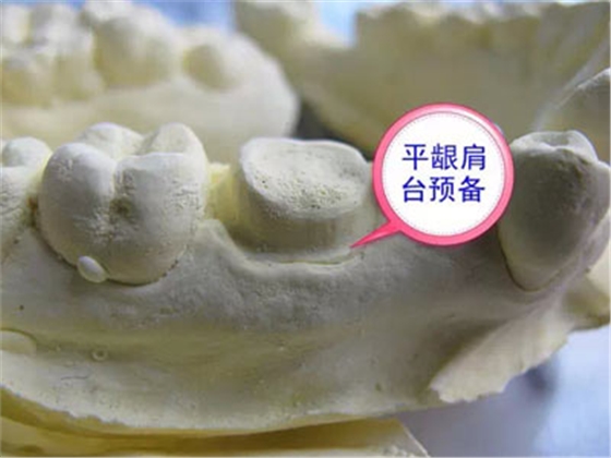 備牙應(yīng)注意的事項(xiàng)+備牙取摸損傷牙齦問題