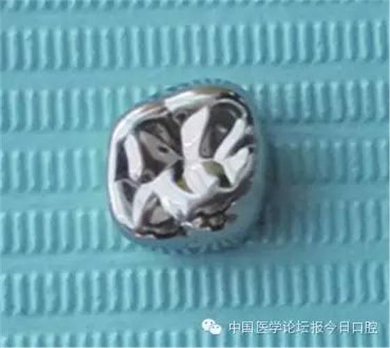 兒童乳牙金屬預(yù)成冠的臨床應(yīng)用 兒童乳牙金屬預(yù)成冠的臨床應(yīng)用