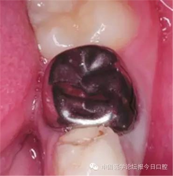 兒童乳牙金屬預(yù)成冠的臨床應(yīng)用 兒童乳牙金屬預(yù)成冠的臨床應(yīng)用