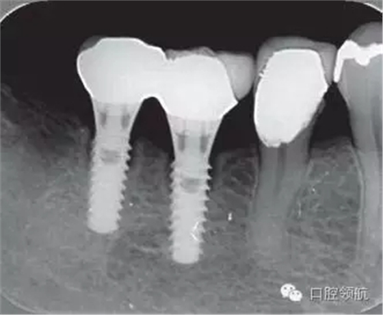 種植體周?chē)霈F(xiàn)伴有骨密度增加現(xiàn)象的骨吸收