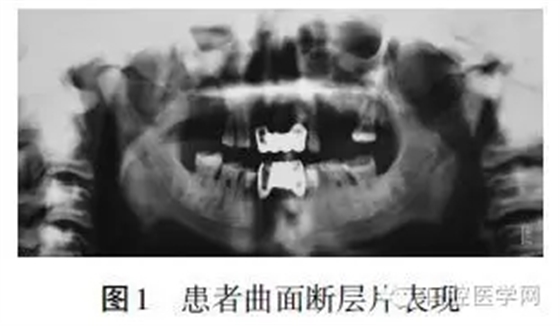 頜骨骨髓炎X線影像