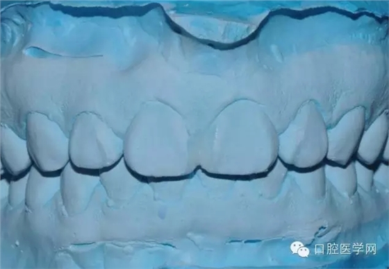 樹脂關(guān)閉前牙間隙