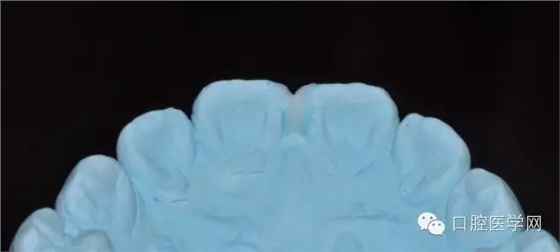 樹脂關(guān)閉前牙間隙