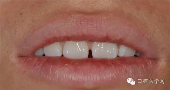 樹脂關(guān)閉前牙間隙