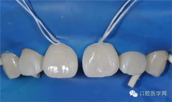 樹脂關(guān)閉前牙間隙