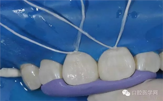 樹脂關(guān)閉前牙間隙