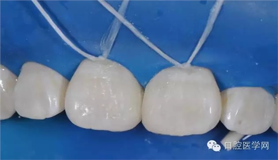 樹脂關(guān)閉前牙間隙