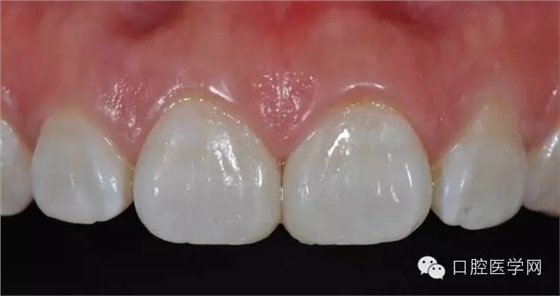 樹脂關(guān)閉前牙間隙