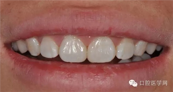 樹脂關(guān)閉前牙間隙