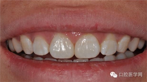 樹脂關(guān)閉前牙間隙
