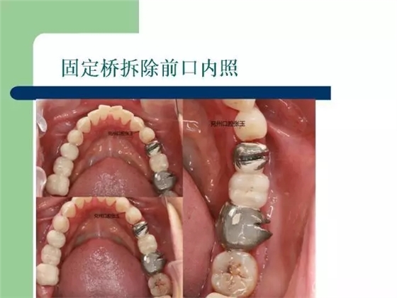 左下后牙不良修復體拆除后重新修復一例