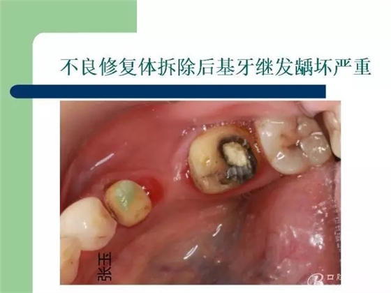 左下后牙不良修復體拆除后重新修復一例