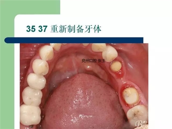 左下后牙不良修復體拆除后重新修復一例