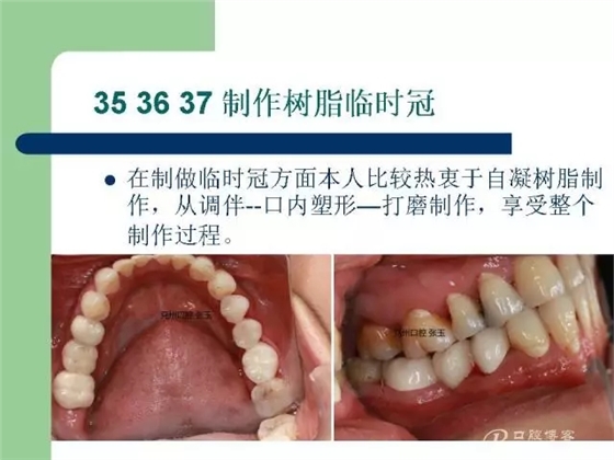 左下后牙不良修復體拆除后重新修復一例