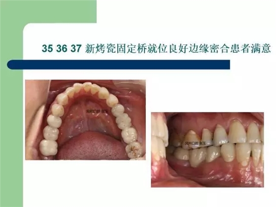 左下后牙不良修復體拆除后重新修復一例