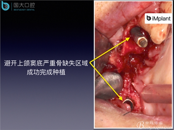 上頜竇底區(qū)域嚴(yán)重骨吸收的臨床種植案例.jpeg