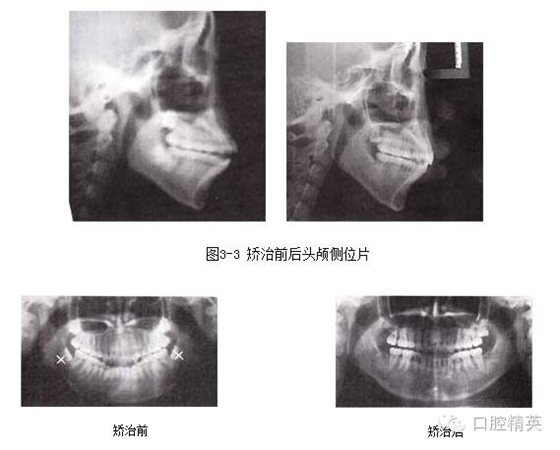 拔牙矯治開頜伴前突