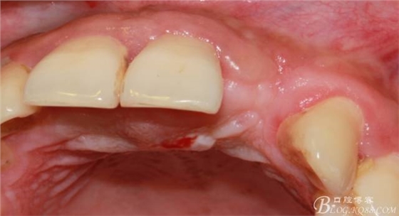 【征文大賽】一例上前牙種植失敗病例的補救--梁光強(qiáng)