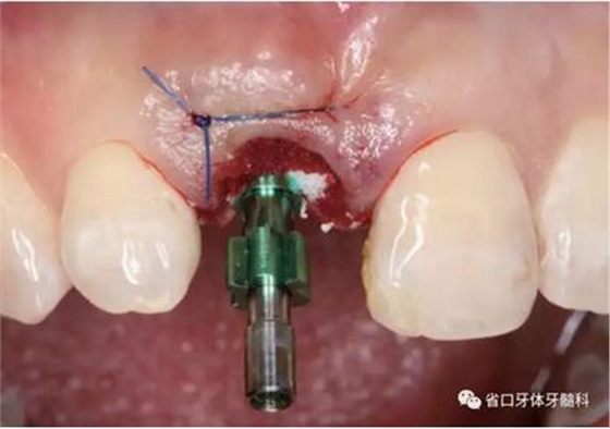 右上前牙即刻種植即刻修復(fù)1例