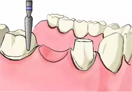圖解：種牙與鑲牙的區(qū)別，缺牙的趕緊看.png
