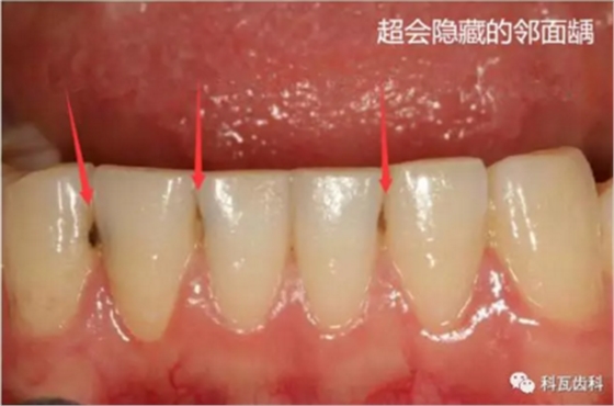 牙縫間的黑線是鄰面齲，還一壞壞倆，巧用它幫你渡過一“劫”