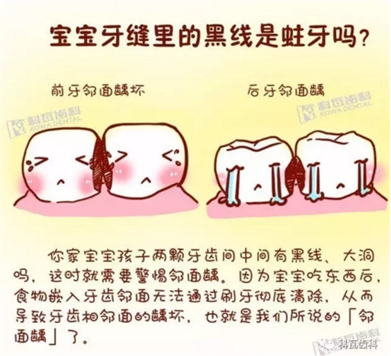 牙縫間的黑線是鄰面齲，還一壞壞倆，巧用它幫你渡過一“劫”