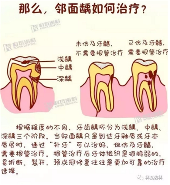 牙縫間的黑線是鄰面齲，還一壞壞倆，巧用它幫你渡過一“劫”