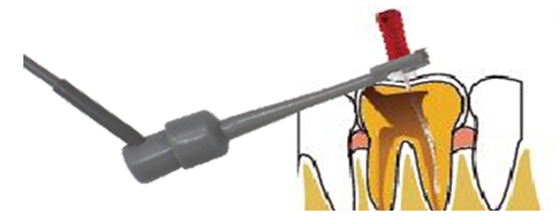 根管長(zhǎng)度測(cè)量?jī)x的使用 根管長(zhǎng)度測(cè)量?jī)x的使用