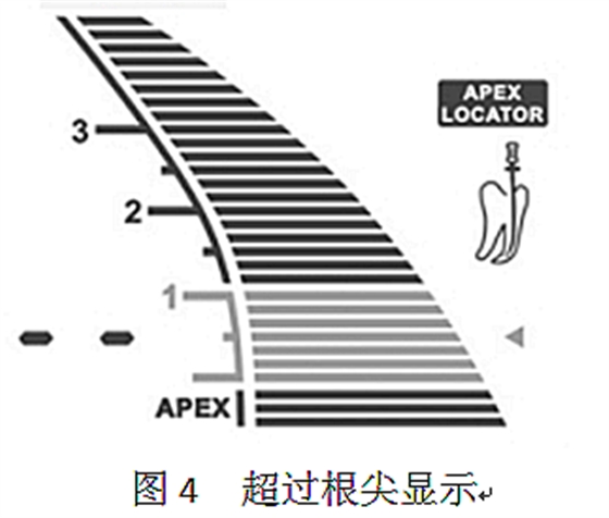 根管長(zhǎng)度測(cè)量?jī)x的使用 根管長(zhǎng)度測(cè)量?jī)x的使用