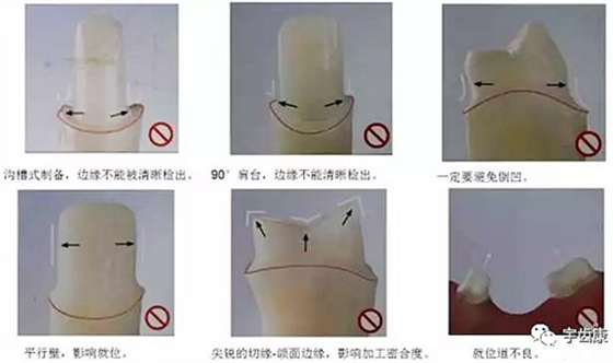 影響全瓷牙冠裂的因素有哪些？