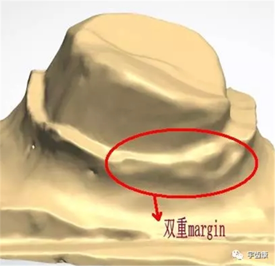 影響全瓷牙冠裂的因素有哪些？