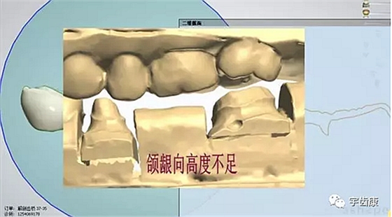 影響全瓷牙冠裂的因素有哪些？