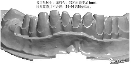 影響全瓷牙冠裂的因素有哪些？