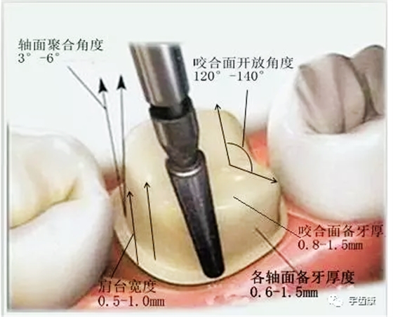 影響全瓷牙冠裂的因素有哪些？