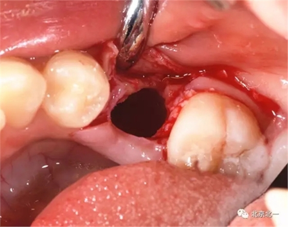 微創(chuàng)舒適拔埋伏牙病 微創(chuàng)舒適拔埋伏牙病