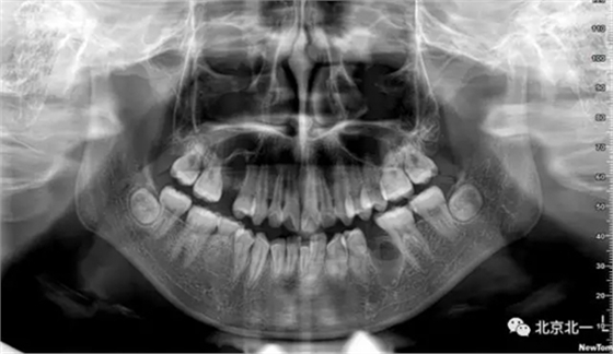 微創(chuàng)舒適拔埋伏牙病 微創(chuàng)舒適拔埋伏牙病