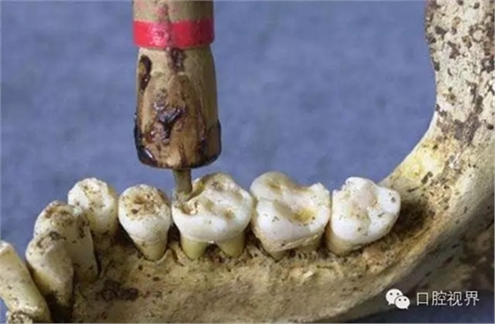 以前牙醫(yī)是怎樣虐待人們牙齒的？ 看完了就知道現(xiàn)在看牙多舒適了！