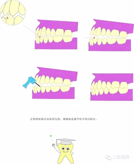 【愛牙科普知識300問】 “什么是牙間牽引？”